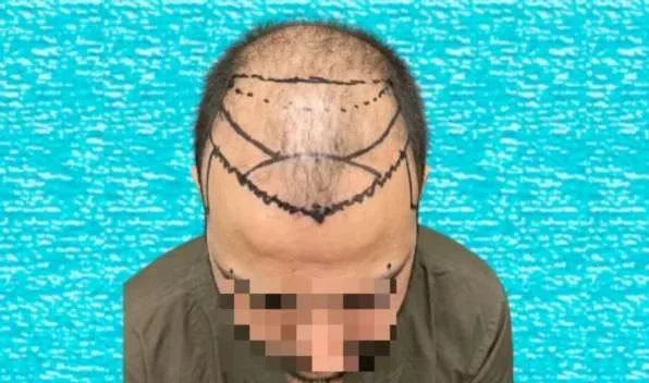 Hairline design marked on the scalp before EnRiched-FUE hair transplant surgery