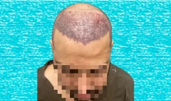 Scalp immediately after EnRiched-FUE hair transplant with 3780 implanted grafts