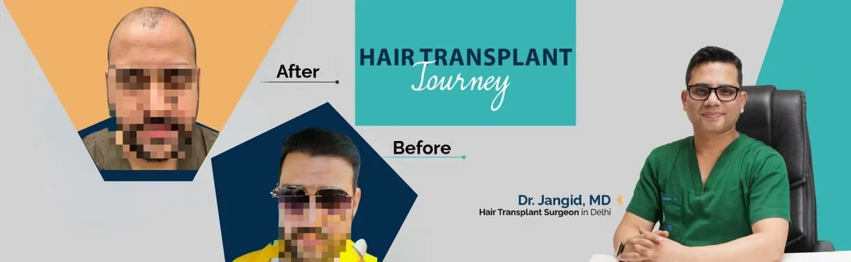 Hair transplant journey before and after by Dr. Jangid, hair transplant surgeon in Delhi