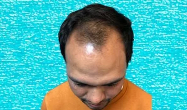 Top view of the scalp before hair transplant showing thinning across the front and mid-scalp