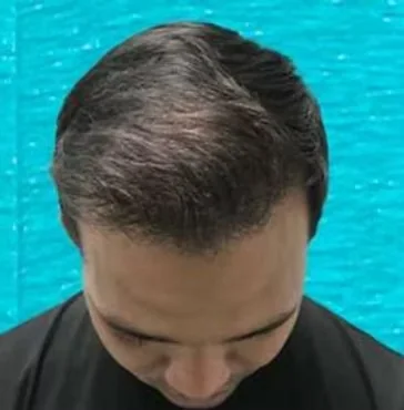 Close-up of the new hairline after hair transplant by Dr. Jangid