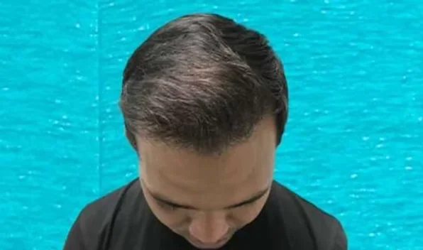After hair transplant: restored density across the front and mid-scalp with 2800 grafts