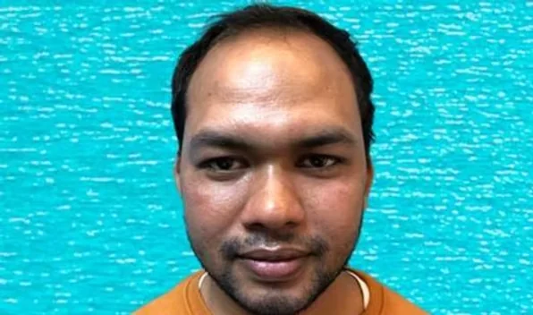 Patient at first visit before hair transplant, front view, showing Norwood grade 4 hair loss