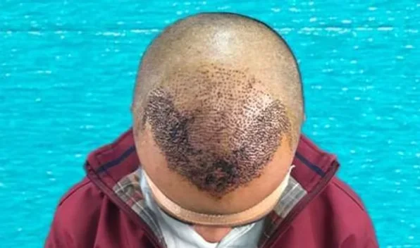 Scalp immediately after EnRiched-FUE hair transplant showing 2800 implanted grafts