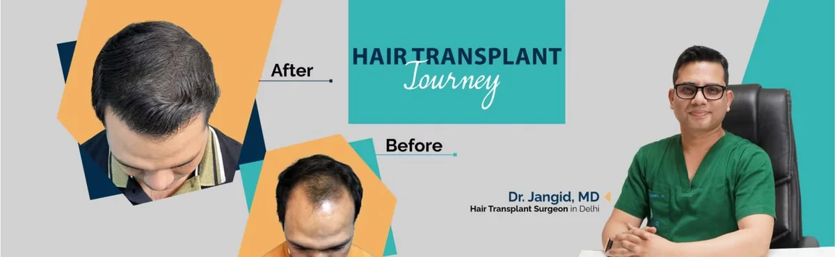 Hair transplant journey before and after by Dr. Jangid, hair transplant surgeon in Delhi