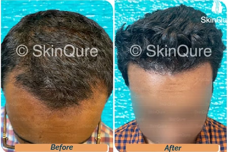 Hair transplant case study 1 in Delhi – 27-year-old male, Norwood 3, 3,050 grafts with EnRiched-FUE, result at 8 Months