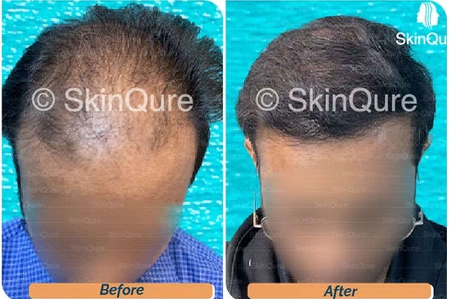 Hair transplant case study 2 in Delhi – 28 male, NW-4+, 3,310 Grafts with Bio-FUE, result at 6 Months