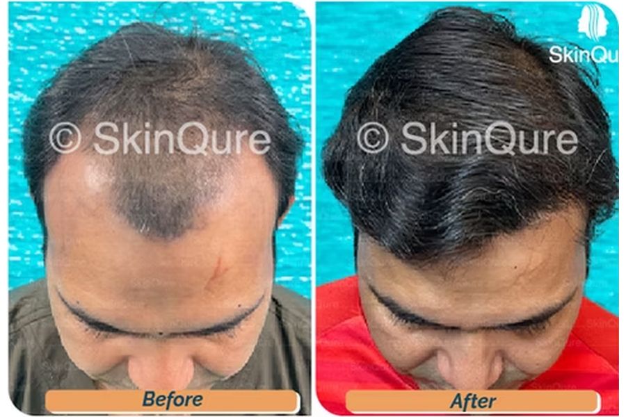 Hair transplant case study 3 in Delhi – 31 male, NW-4+, 3,150 Grafts with EnRiched-FUE, result at 8 Months