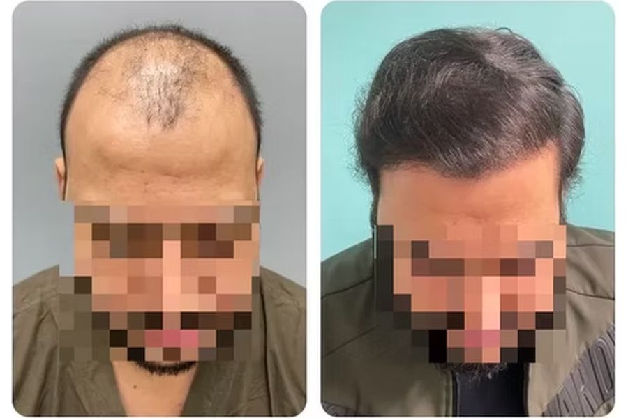Hair transplant case study 4 in Delhi – 29 male, NW-5, 3,348 Grafts with EnRiched-FUE, result at 6 Months