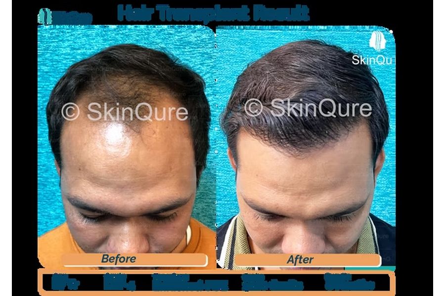 Hair transplant before and after case study 5 at SkinQure, Delhi