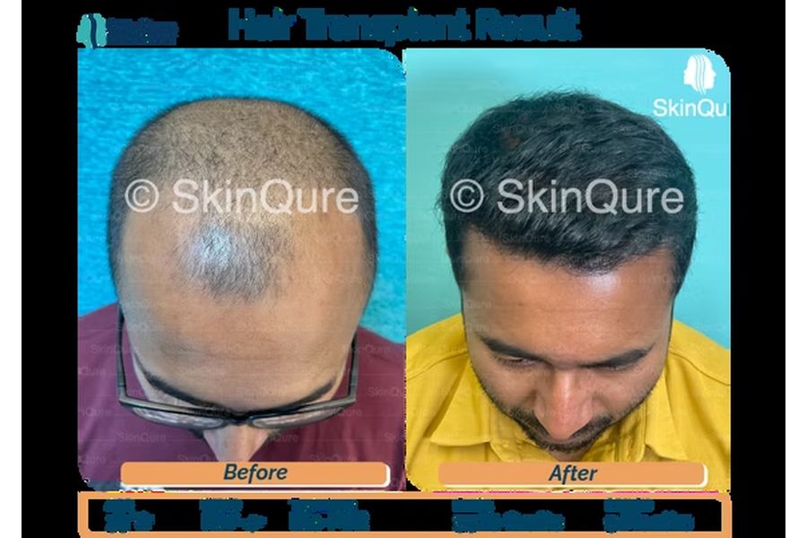Hair transplant case study 6 in Delhi – 33-year-old male, Norwood grade 4 to 5, 3,320 grafts with EnRiched-FUE, result at 8 months