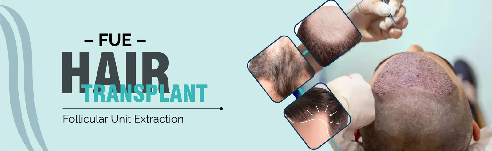 FUE Hair Transplant - Follicular Unit Extraction at SkinQure Delhi