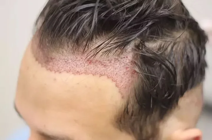 Calculating the number of hair grafts required for a hair transplant