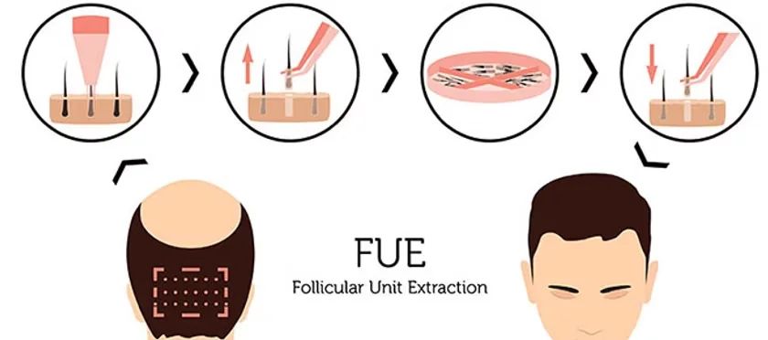 Recipient sites being created on the scalp before graft placement