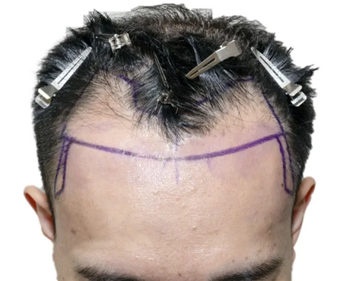 Surgeon harvesting follicular unit grafts from the donor area