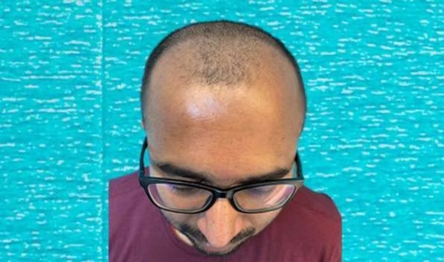 Before hair transplant: Norwood grade 4 to 5 hair loss on the front and mid-scalp