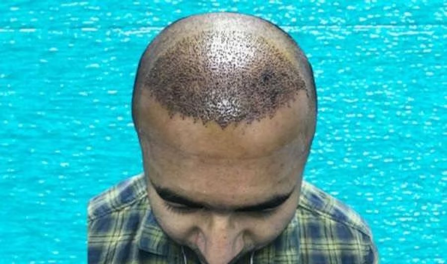 Scalp immediately after EnRiched-FUE hair transplant with 3,320 grafts implanted