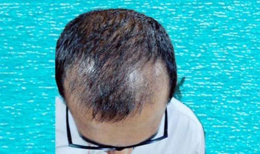 Hair transplant result two months after surgery at SkinQure, Delhi