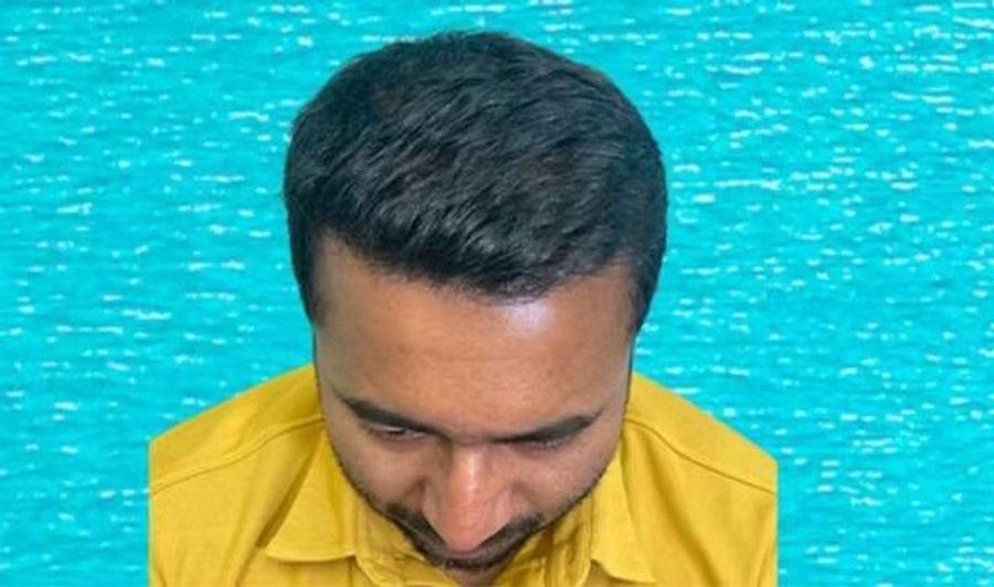 After hair transplant: full frontal coverage eight months after 3,320 grafts