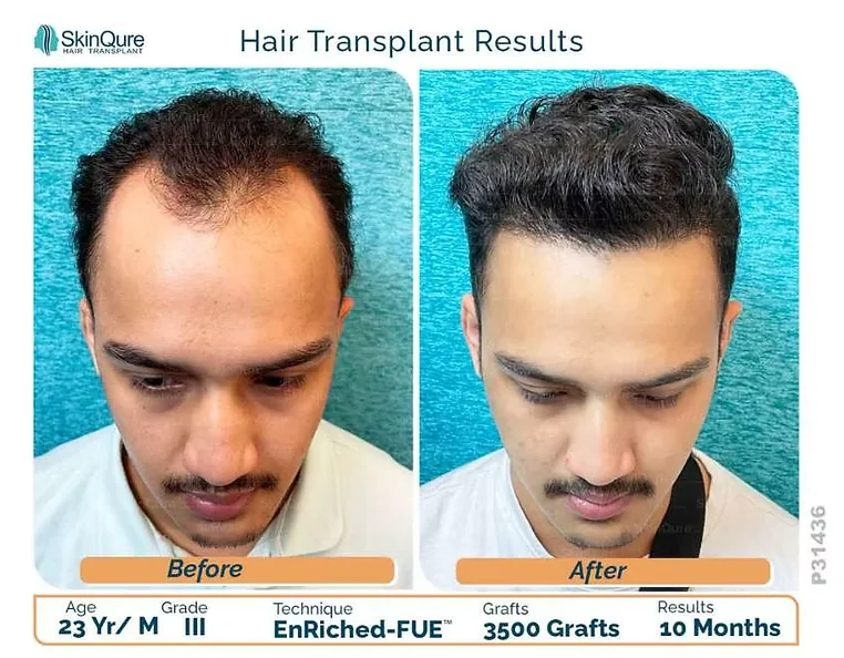 Hair transplant result - 23 Yr male, Grade III, 3,500 grafts, 10 months after EnRiched-FUE at SkinQure Delhi