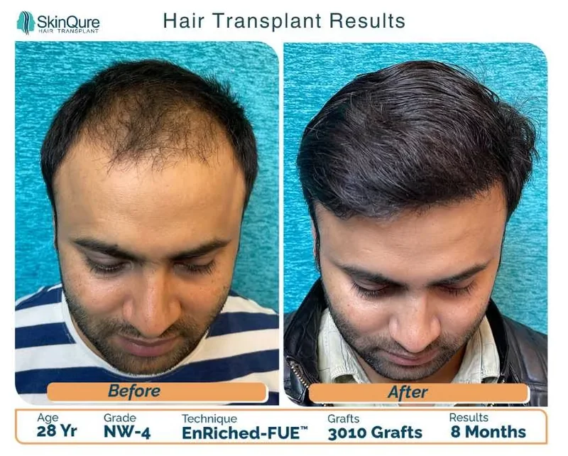 Hair transplant result - 28 Yr male, NW-4, 3,010 grafts, 8 months after EnRiched-FUE at SkinQure Delhi