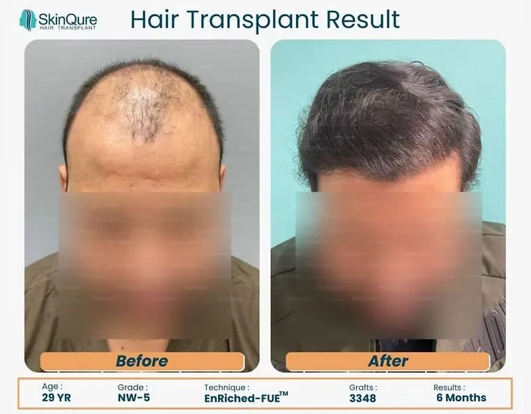 Hair transplant result - 29 Yr male, NW-5, 3,348 grafts, 6 months after EnRiched-FUE at SkinQure Delhi