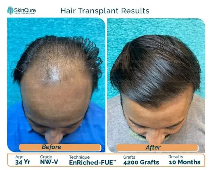 Hair transplant result - 34 Yr male, NW-V, 4,200 grafts, 10 months after EnRiched-FUE at SkinQure Delhi