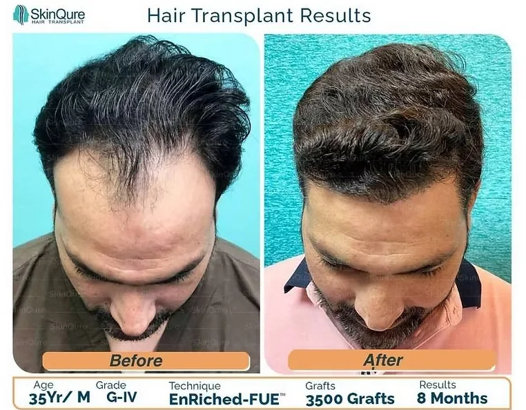 Hair transplant result - 35 Yr male, Grade IV, 3,500 grafts, 8 months after EnRiched-FUE at SkinQure Delhi