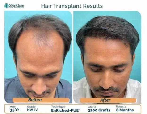 Hair transplant result - 35 Yr male, NW-IV, 3,200 grafts, 8 months after EnRiched-FUE at SkinQure Delhi