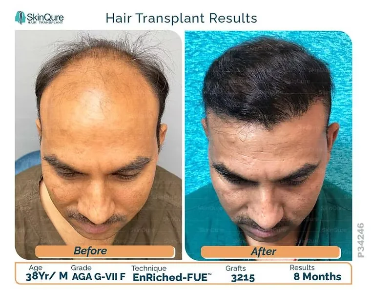 Hair transplant result - 38 Yr male, AGA G-VII, 3,215 grafts, 8 months after EnRiched-FUE at SkinQure Delhi