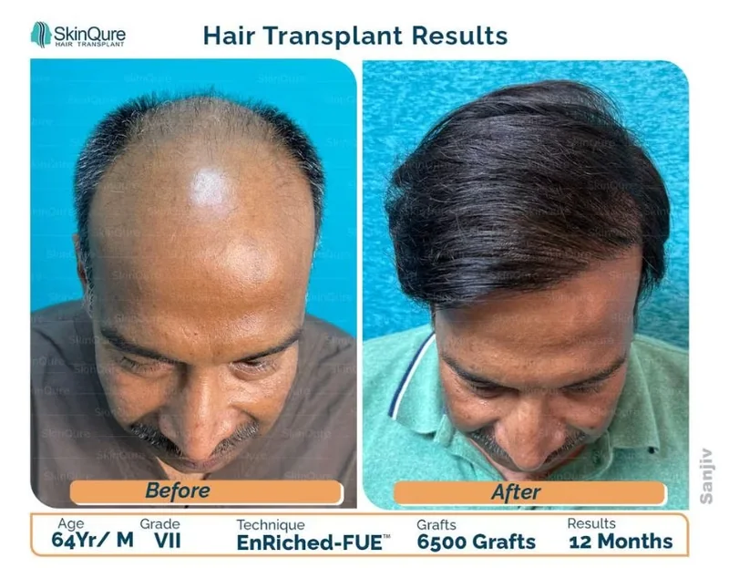 Hair transplant result - 64 Yr male, Grade VII, 6,500 grafts, 12 months after EnRiched-FUE at SkinQure Delhi