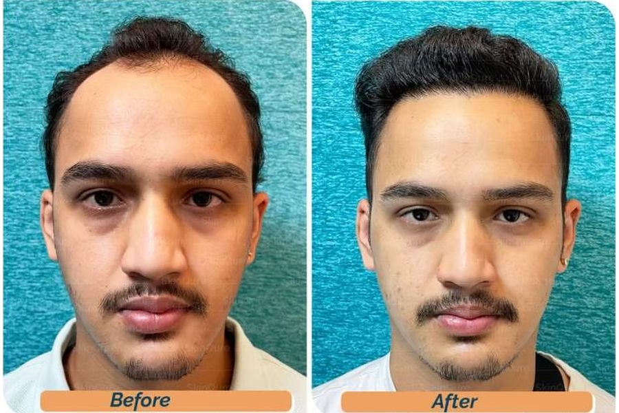 Hair transplant before and after in Delhi – 23-year-old male, Norwood III, 3,500 grafts with EnRiched-FUE, result at 10 months (photo 1)