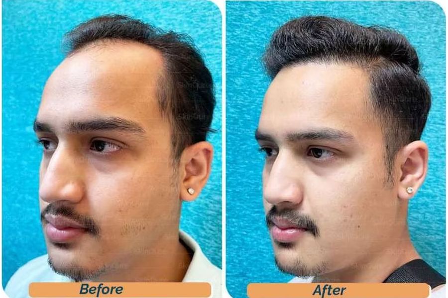 Hair transplant before and after in Delhi – 23-year-old male, Norwood III, 3,500 grafts with EnRiched-FUE, result at 10 months (photo 2)