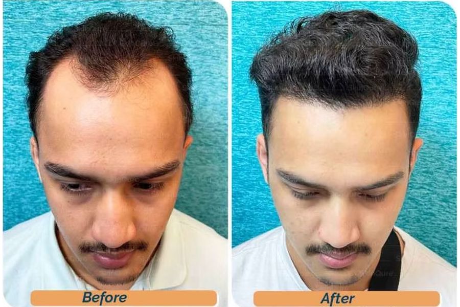 Hair transplant before and after in Delhi – 23-year-old male, Norwood III, 3,500 grafts with EnRiched-FUE, result at 10 months (photo 3)