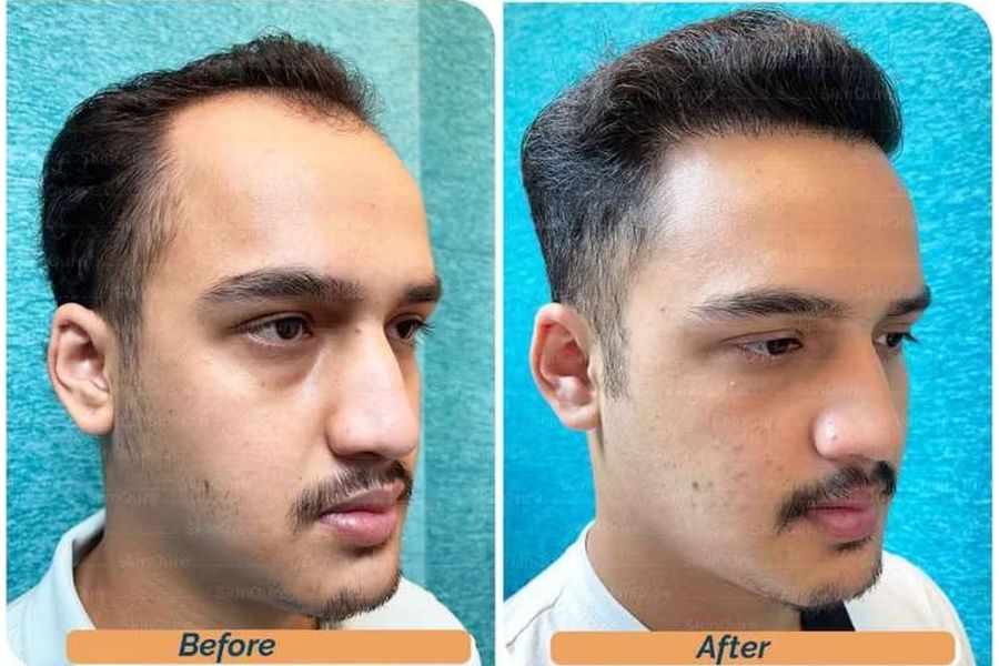 Hair transplant before and after in Delhi – 23-year-old male, Norwood III, 3,500 grafts with EnRiched-FUE, result at 10 months (photo 4)