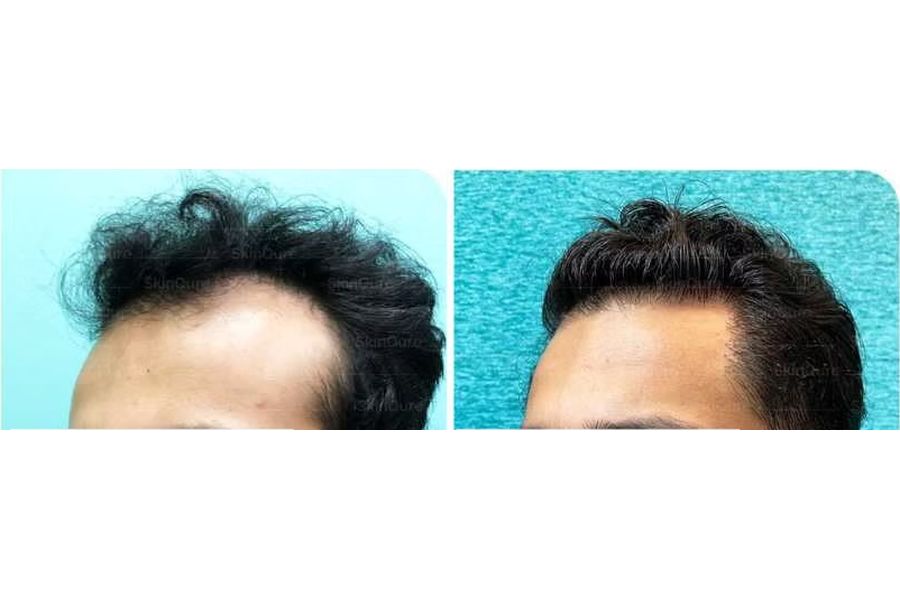 Hair transplant before and after in Delhi – 23-year-old male, Norwood IVa, 4,200 grafts with EnRiched-FUE, result at 7 months (photo 1)
