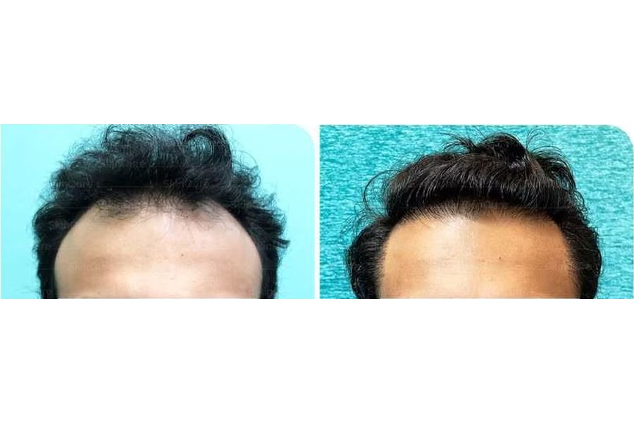 Hair transplant before and after in Delhi – 23-year-old male, Norwood IVa, 4,200 grafts with EnRiched-FUE, result at 7 months (photo 2)