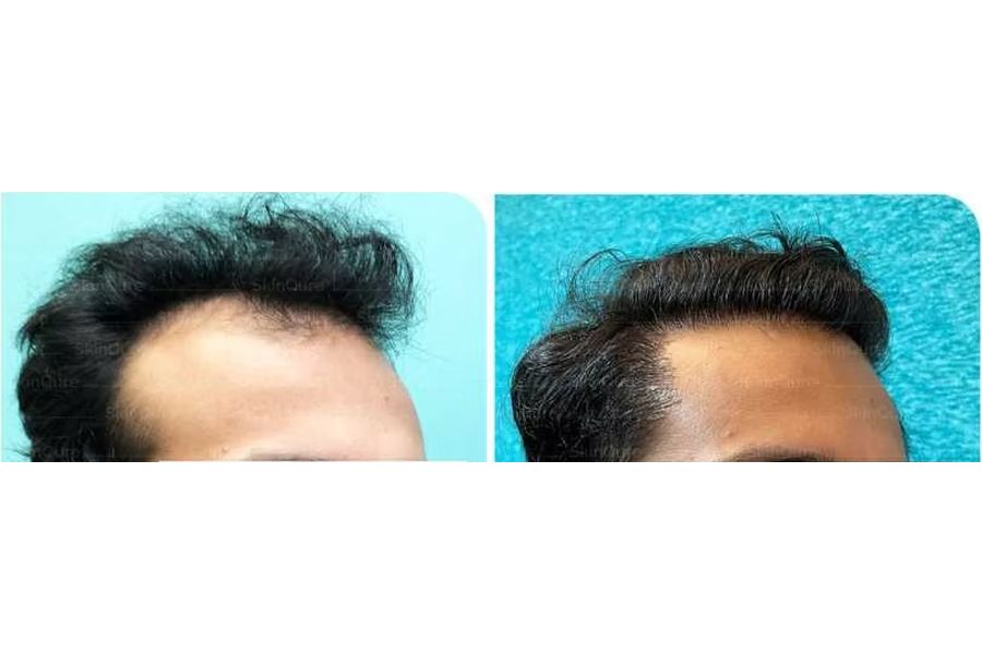 Hair transplant before and after in Delhi – 23-year-old male, Norwood IVa, 4,200 grafts with EnRiched-FUE, result at 7 months (photo 3)
