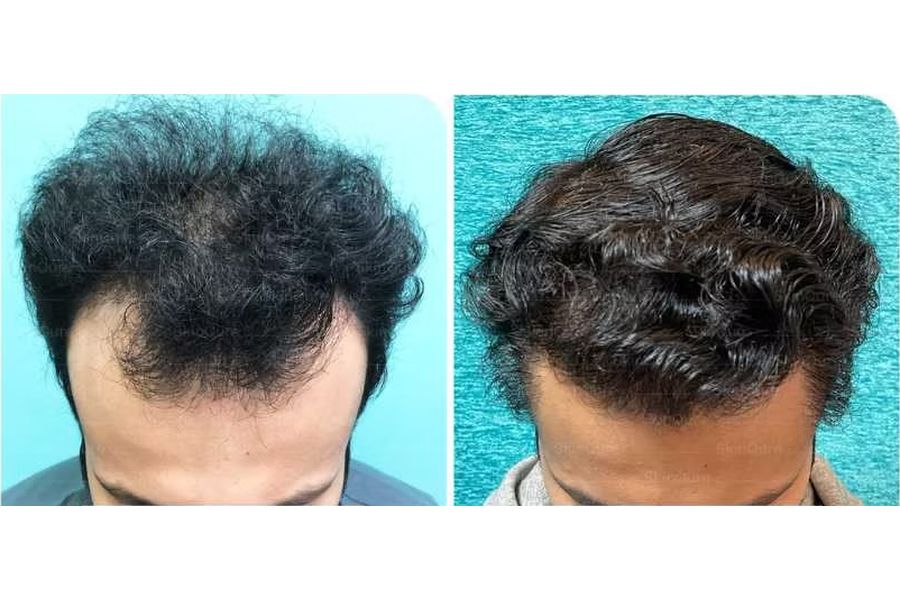 Hair transplant before and after in Delhi – 23-year-old male, Norwood IVa, 4,200 grafts with EnRiched-FUE, result at 7 months (photo 4)