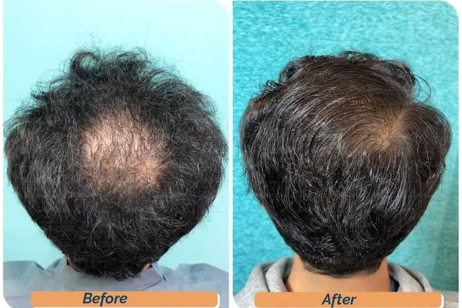 Hair transplant before and after in Delhi – 23-year-old male, Norwood IVa, 4,200 grafts with EnRiched-FUE, result at 7 months (photo 5)