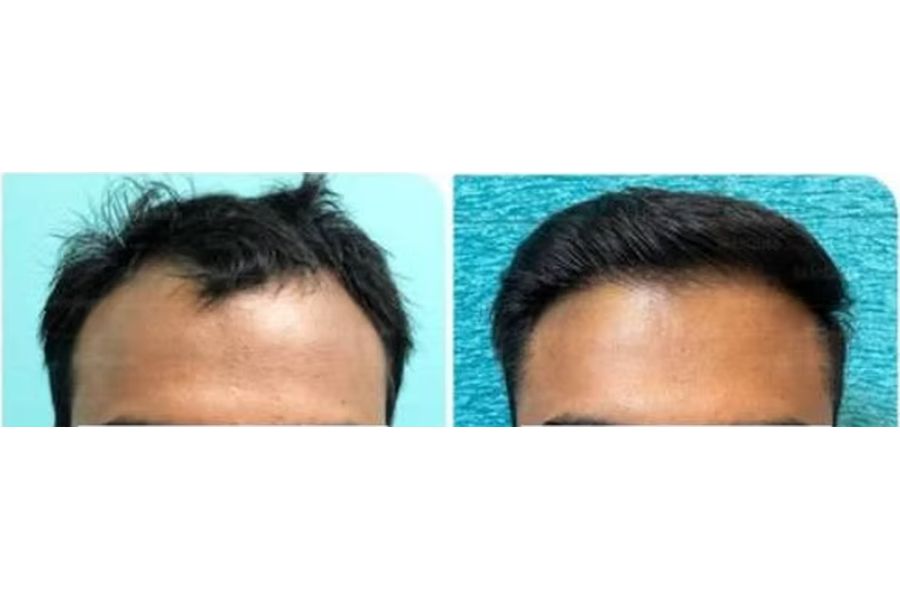 Hair transplant before and after in Delhi – 24-year-old male, Norwood III, 2,600 grafts with EnRiched-FUE, result at 7 months (photo 1)