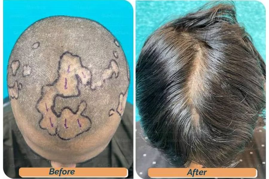 Hair transplant before and after in Delhi – 24-year-old male, Scarring Alopecia, 3,300 grafts with EnRiched-FUE, result at 8 months (photo 1)