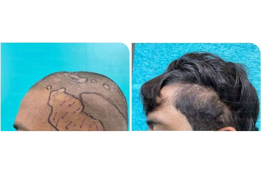 Hair transplant before and after in Delhi – 24-year-old male, Scarring Alopecia, 3,300 grafts with EnRiched-FUE, result at 8 months (photo 2)