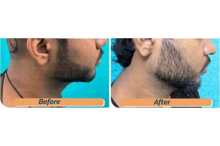 Hair transplant before and after in Delhi – 24-year-old male, Scarring Alopecia, 3,300 grafts with EnRiched-FUE, result at 8 months (photo 3)