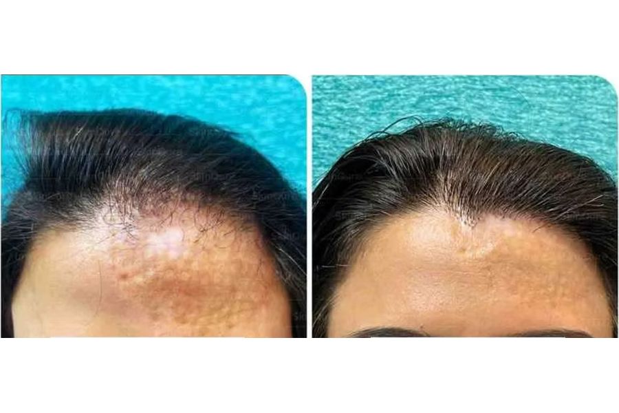Hair transplant before and after in Delhi – 25-year-old female, Traumatic Hair Loss, 500 grafts with EnRiched-FUE, result at 11 months (photo 1)