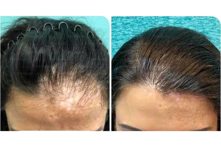 Hair transplant before and after in Delhi – 25-year-old female, Traumatic Hair Loss, 500 grafts with EnRiched-FUE, result at 11 months (photo 2)