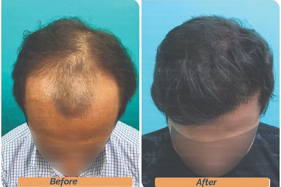 Hair transplant before and after in Delhi – 26-year-old male, Norwood V, 3,450 grafts with EnRiched-FUE, result at 8 months (photo 1)