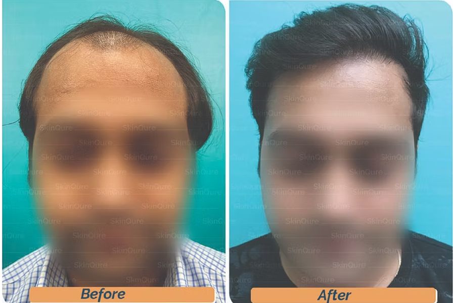 Hair transplant before and after in Delhi – 26-year-old male, Norwood V, 3,450 grafts with EnRiched-FUE, result at 8 months (photo 2)