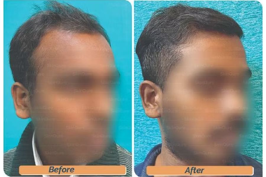 Hair transplant before and after in Delhi – 27-year-old male, Norwood III, 2,800 grafts with EnRiched-FUE, result at 8 months (photo 1)