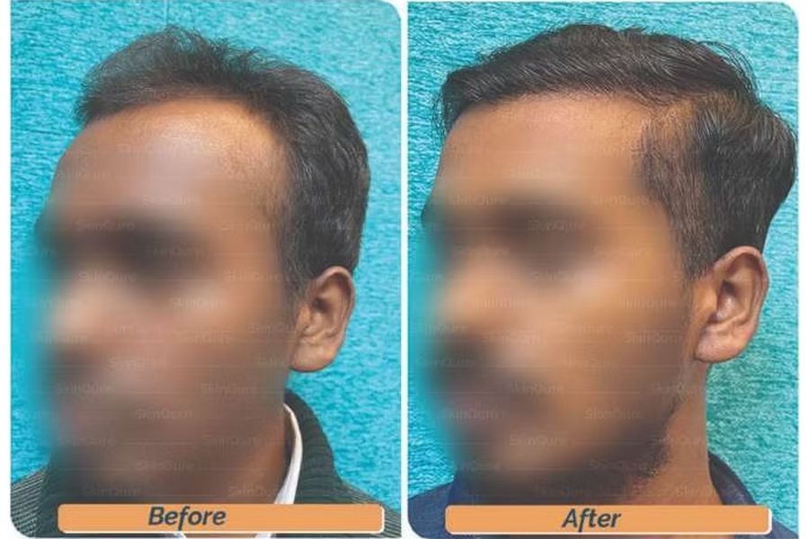 Hair transplant before and after in Delhi – 27-year-old male, Norwood III, 2,800 grafts with EnRiched-FUE, result at 8 months (photo 2)
